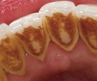 teeth before Cosmetic Dentistry Teeth Whitening