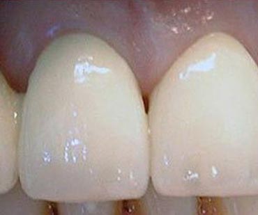 white teeth after cosmetic dental procedures