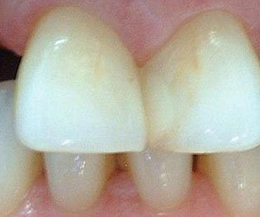 discolored teeth before cosmetic dental procedures