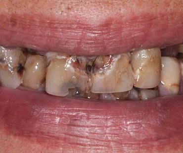 damaged and discolored teeth before cosmetic dentistry