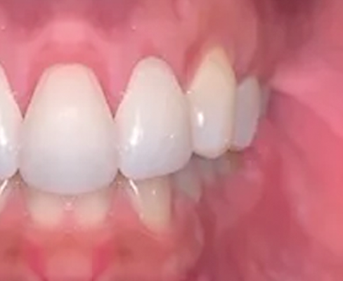 white teeth after being treated