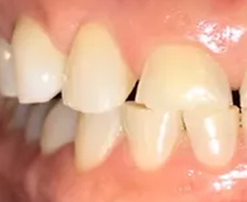 discolored teeth before being treated