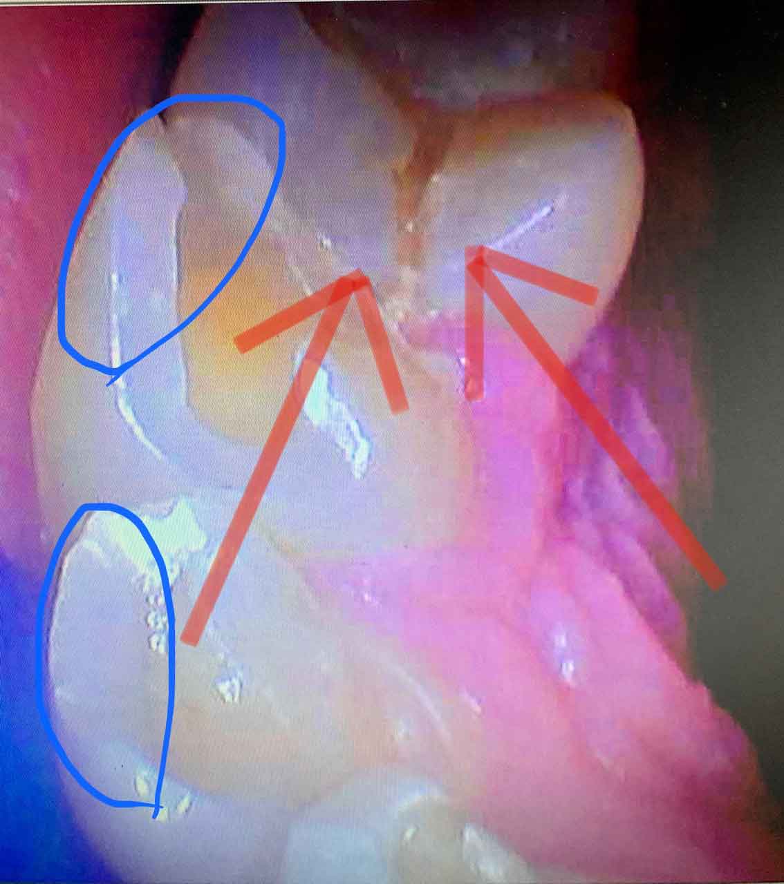 damaged tooth without the help of a night guard