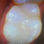 repaired tooth with a composite filling