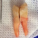 removed split tooth that could have been protected by a night guard