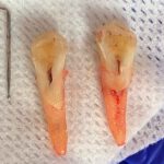 removed tooth with two split halves