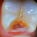 damaged tooth rotting from the inside out