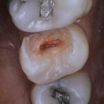 damaged tooth with a cavity that's making the nerve bleed