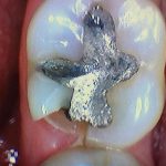 damaged tooth with a silver filling