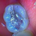damaged tooth before getting a filling