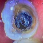 damaged tooth with interior rot and decay