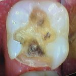 damaged tooth with decay