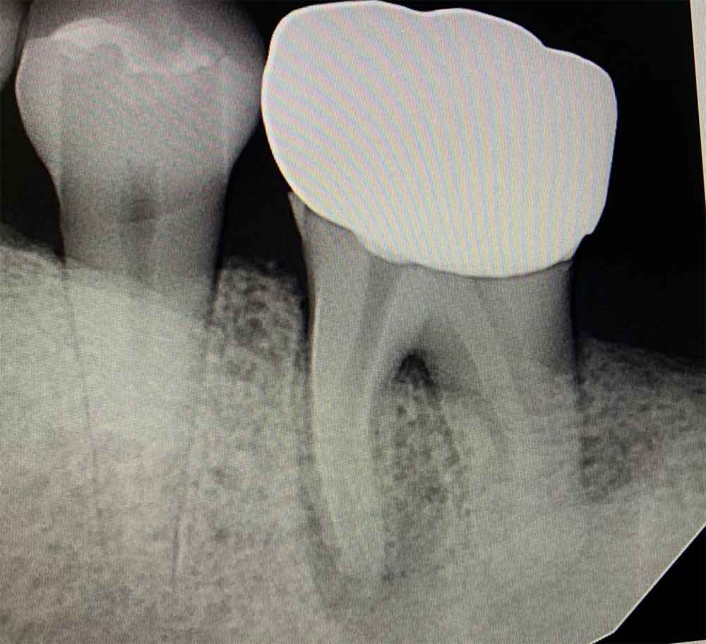 dental x-ray of a tooth and its roots