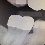 teeth x-ray of a damaged tooth